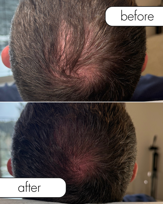 Everything You Need to Know About Scalp Micropigmentation with N8KED Beauty